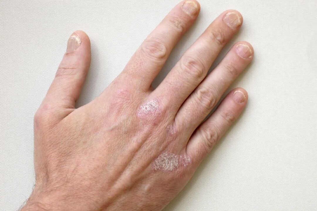 psoriáza na rukou muže léčba krémem Keramin