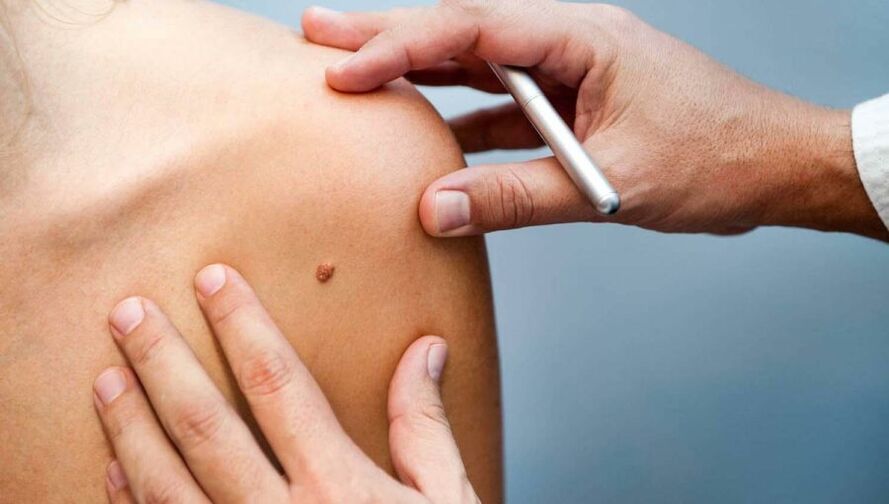 Dermatolog vyšetřující pacienta s papilomem