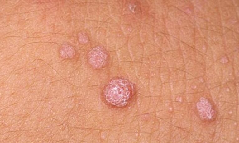HPV vede ke vzniku kožních papilomů