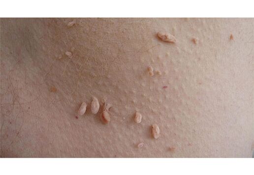 Známkou infekce HPV je výskyt papilomů na těle