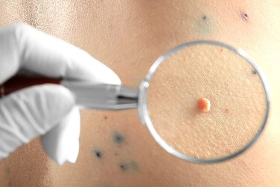 Léčba HPV