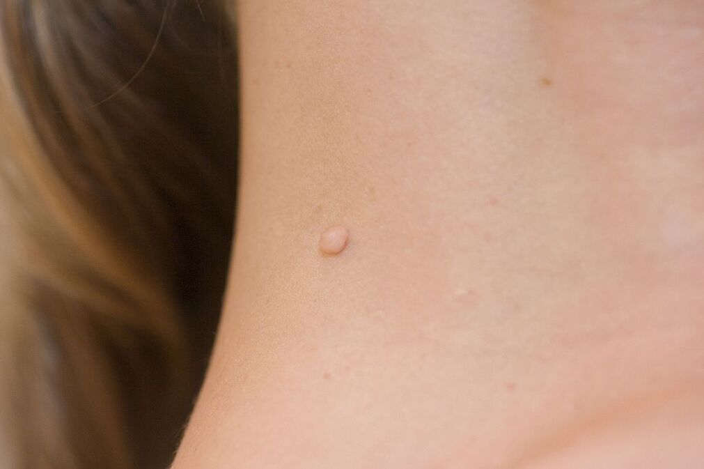 příznaky HPV